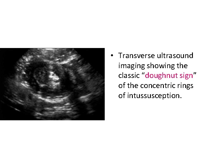  • Transverse ultrasound imaging showing the classic “doughnut sign” of the concentric rings