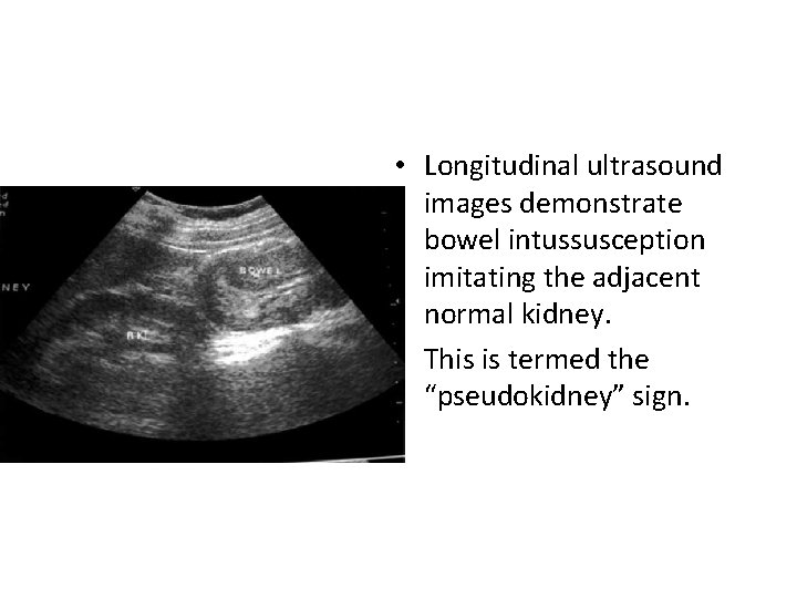  • Longitudinal ultrasound images demonstrate bowel intussusception imitating the adjacent normal kidney. •