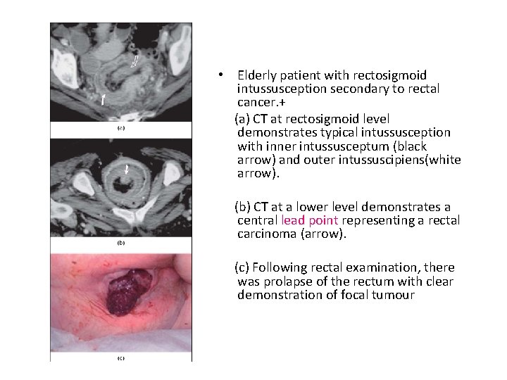  • Elderly patient with rectosigmoid intussusception secondary to rectal cancer. + (a) CT