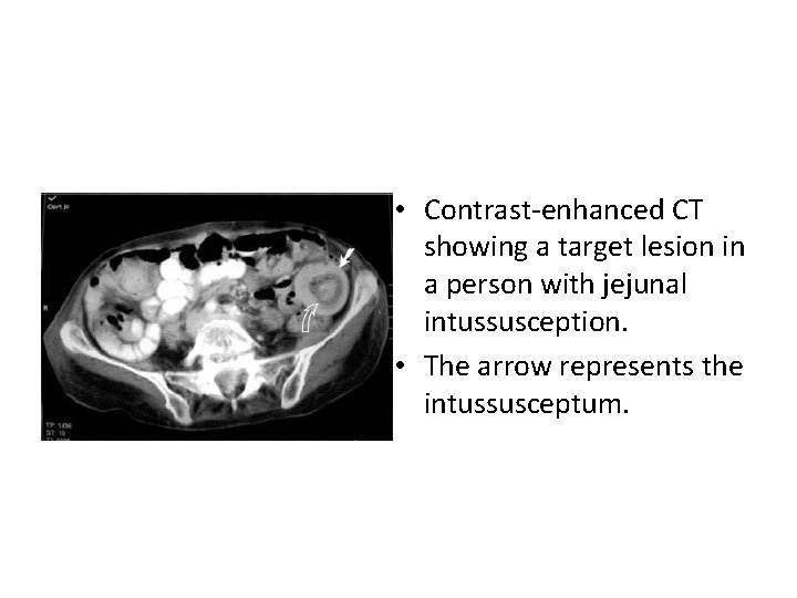  • Contrast-enhanced CT showing a target lesion in a person with jejunal intussusception.