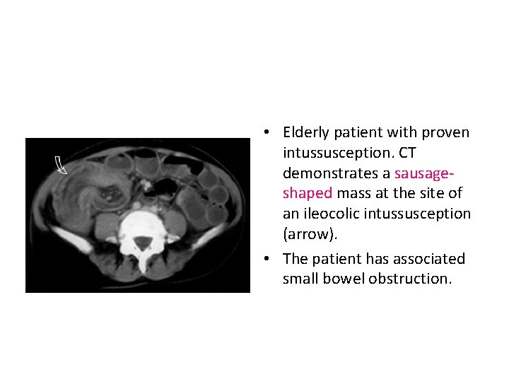  • Elderly patient with proven intussusception. CT demonstrates a sausageshaped mass at the