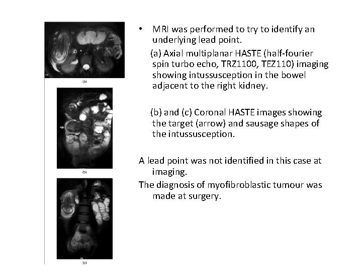  • MRI was performed to try to identify an underlying lead point. (a)