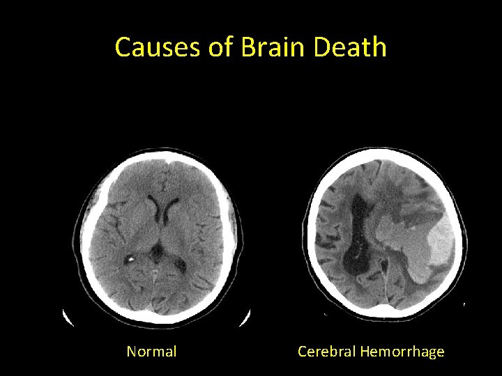 Causes of Brain Death Normal Cerebral Hemorrhage 