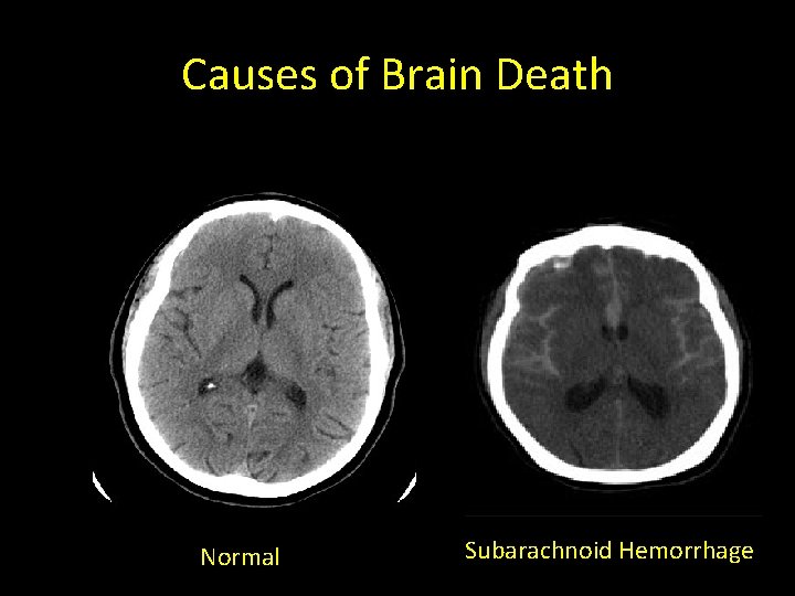 Causes of Brain Death Normal Subarachnoid Hemorrhage 