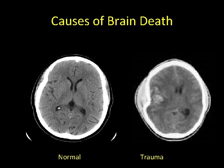 Causes of Brain Death Normal Trauma 