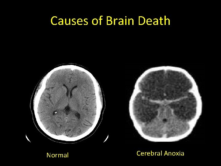 Causes of Brain Death Normal Cerebral Anoxia 