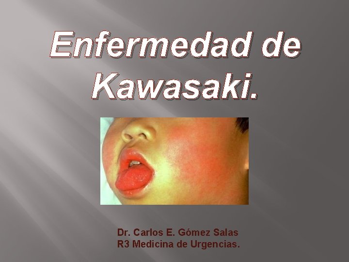 Enfermedad de Kawasaki. Dr. Carlos E. Gómez Salas R 3 Medicina de Urgencias. 