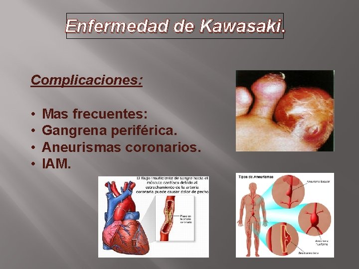 Enfermedad de Kawasaki. Complicaciones: • • Mas frecuentes: Gangrena periférica. Aneurismas coronarios. IAM. 