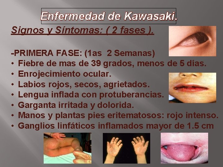 Enfermedad de Kawasaki. Signos y Síntomas: ( 2 fases ). -PRIMERA FASE: (1 as