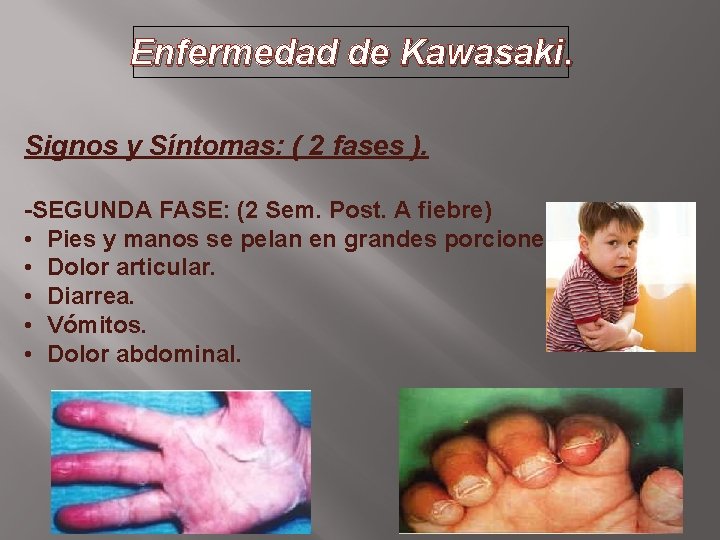 Enfermedad de Kawasaki. Signos y Síntomas: ( 2 fases ). -SEGUNDA FASE: (2 Sem.