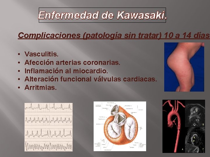 Enfermedad de Kawasaki. Complicaciones (patología sin tratar) 10 a 14 días: • • •