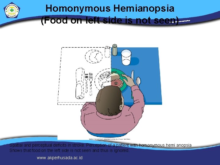 Homonymous Hemianopsia (Food on left side is not seen) Spatial and perceptual deficits in