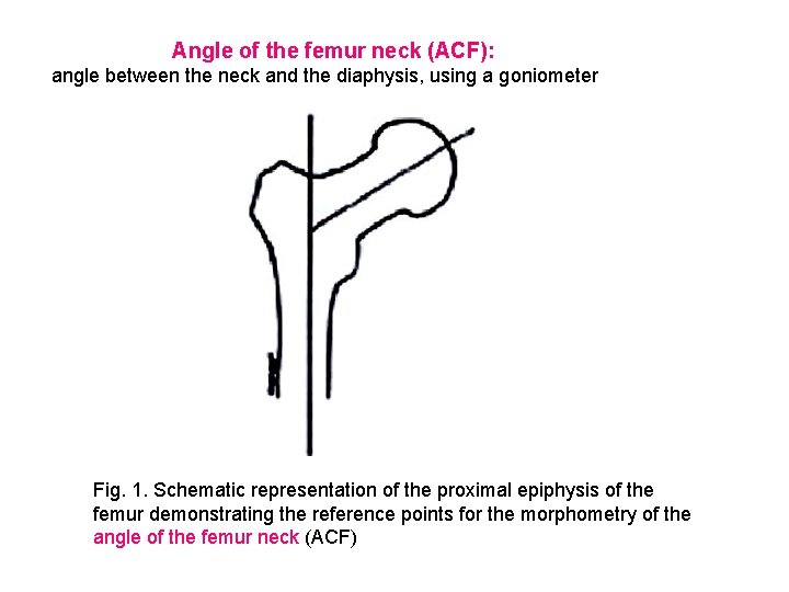  Angle of the femur neck (ACF): angle between the neck and the diaphysis,