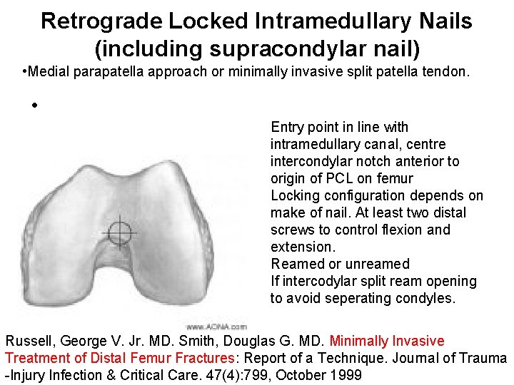 Retrograde Locked Intramedullary Nails (including supracondylar nail) • Medial parapatella approach or minimally invasive