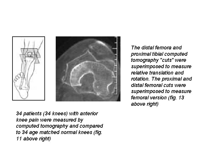 The distal femora and proximal tibial computed tomography "cuts" were superimposed to measure relative