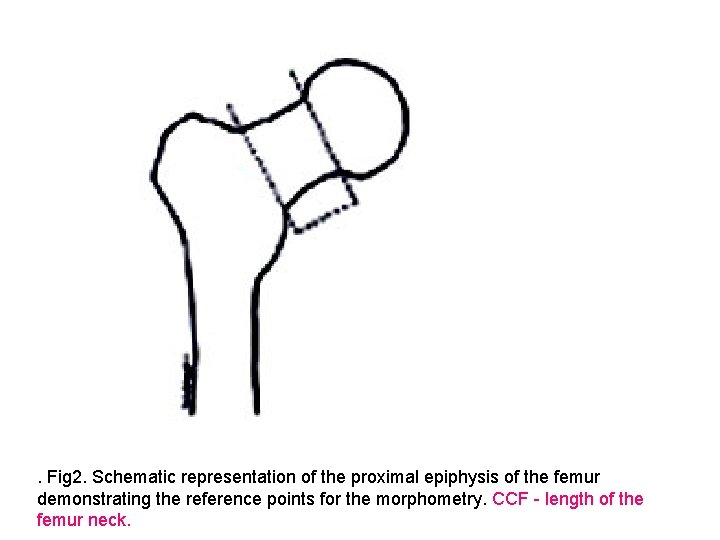 . Fig 2. Schematic representation of the proximal epiphysis of the femur demonstrating the