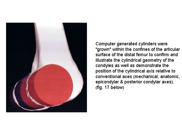 Computer generated cylinders were "grown" within the confines of the articular surface of the