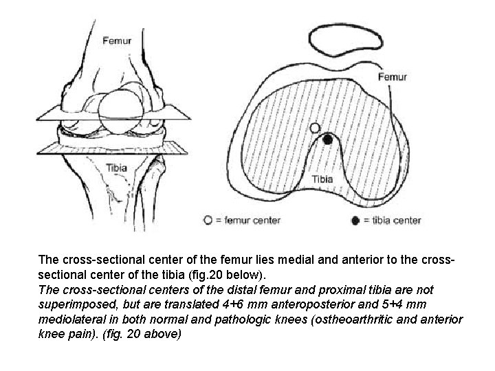 The cross sectional center of the femur lies medial and anterior to the cross