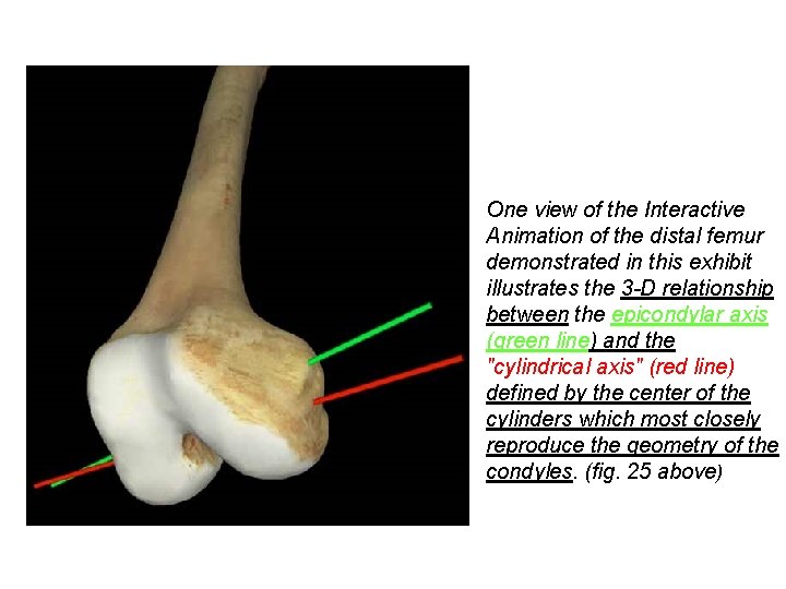 One view of the Interactive Animation of the distal femur demonstrated in this exhibit