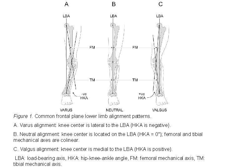 Figure 1. Common frontal plane lower limb alignment patterns. A. Varus alignment: knee center