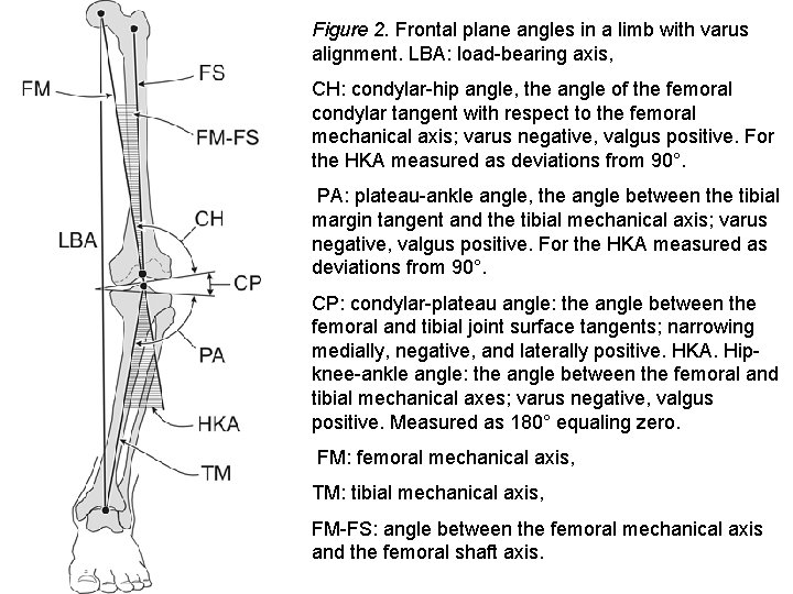 Figure 2. Frontal plane angles in a limb with varus alignment. LBA: load bearing