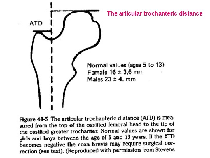 The articular trochanteric distance 