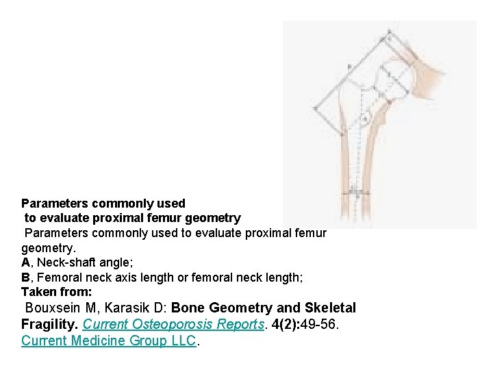 Parameters commonly used to evaluate proximal femur geometry. A, Neck shaft angle; B, Femoral