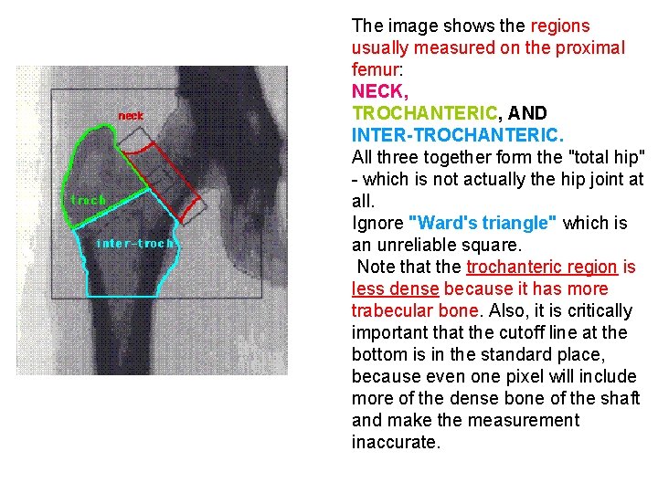 The image shows the regions usually measured on the proximal femur: NECK, TROCHANTERIC, AND