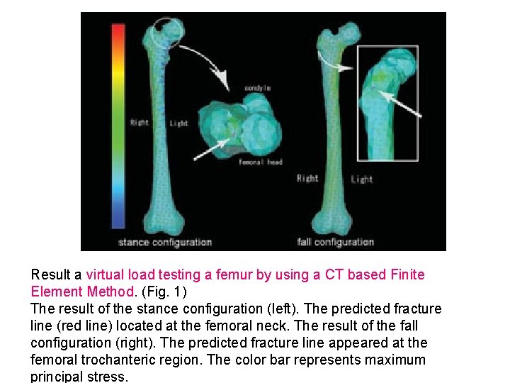 Result a virtual load testing a femur by using a CT based Finite Element