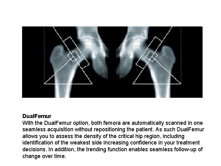Dual. Femur With the Dual. Femur option, both femora are automatically scanned in one