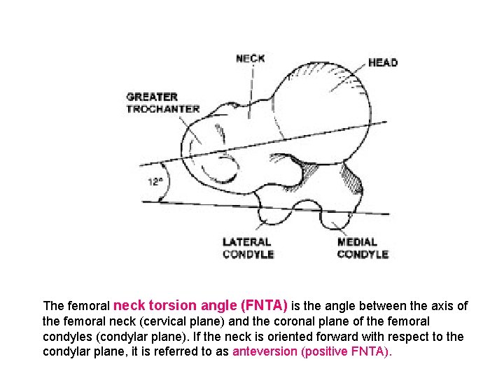 The femoral neck torsion angle (FNTA) is the angle between the axis of the