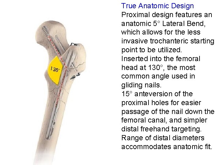 True Anatomic Design Proximal design features an anatomic 5° Lateral Bend, which allows for