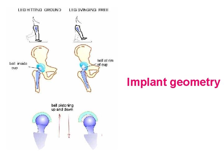 Implant geometry 