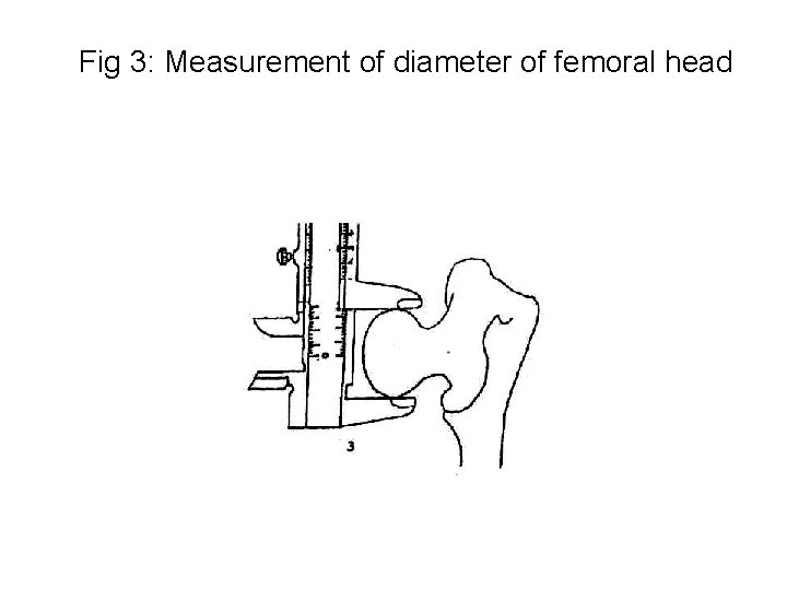 Fig 3: Measurement of diameter of femoral head 