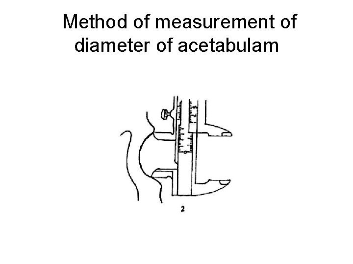  Method of measurement of diameter of acetabulam 