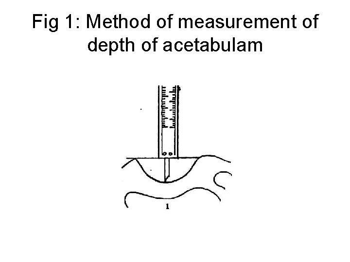 Fig 1: Method of measurement of depth of acetabulam 