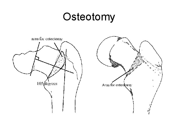 Osteotomy 