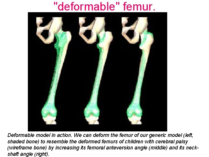 "deformable" femur. Deformable model in action. We can deform the femur of our generic