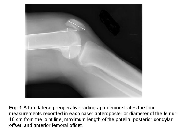 Fig. 1 A true lateral preoperative radiograph demonstrates the four measurements recorded in each