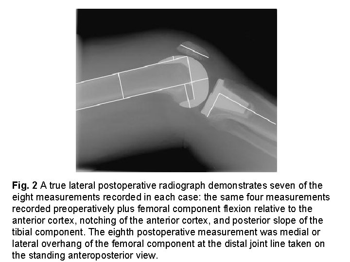 Fig. 2 A true lateral postoperative radiograph demonstrates seven of the eight measurements recorded