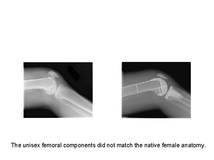 The unisex femoral components did not match the native female anatomy. 