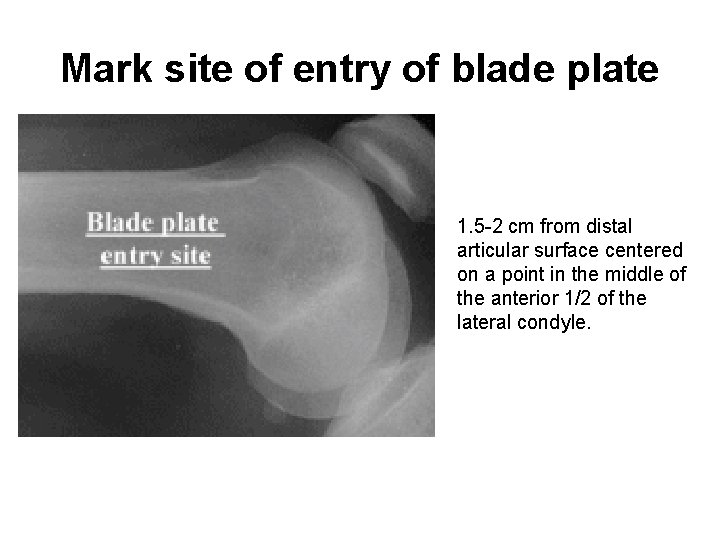 Mark site of entry of blade plate 1. 5 2 cm from distal articular