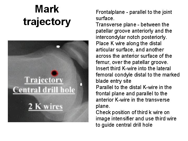 Mark trajectory Frontalplane parallel to the joint surface. Transverse plane between the patellar groove