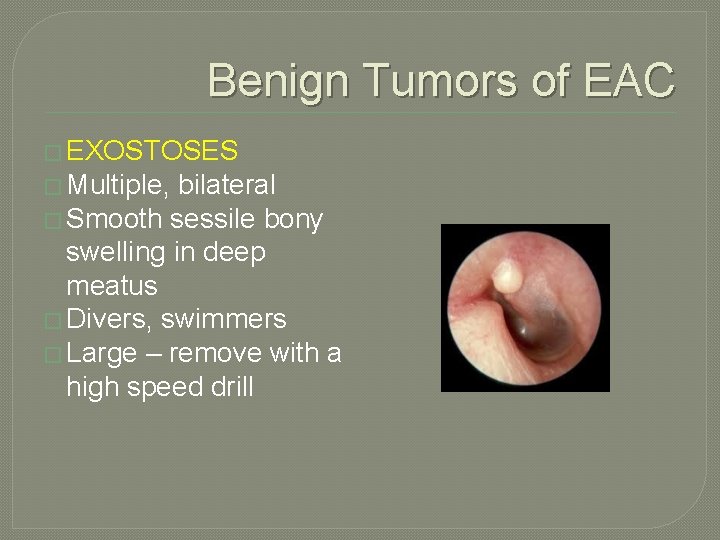 Benign Tumors of EAC � EXOSTOSES � Multiple, bilateral � Smooth sessile bony swelling