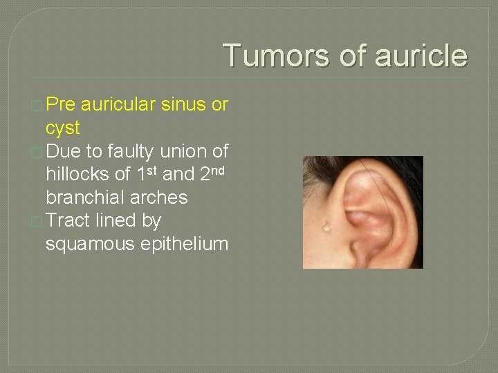 Tumors of auricle � Pre auricular sinus or cyst � Due to faulty union