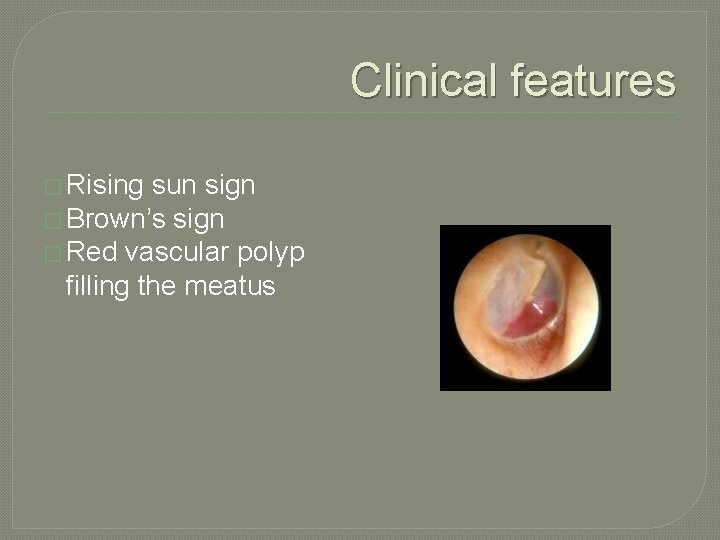 Clinical features � Rising sun sign � Brown’s sign � Red vascular polyp filling