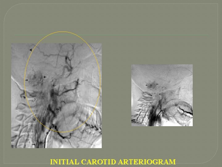 INITIAL CAROTID ARTERIOGRAM 