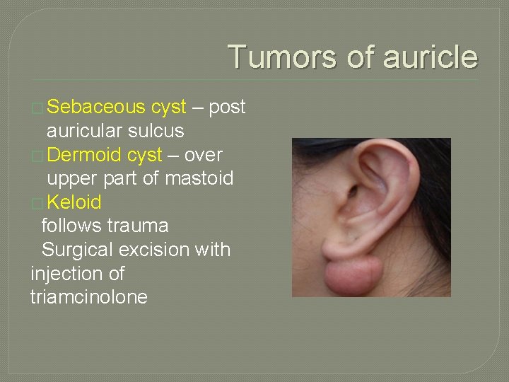 Tumors of auricle � Sebaceous cyst – post auricular sulcus � Dermoid cyst –