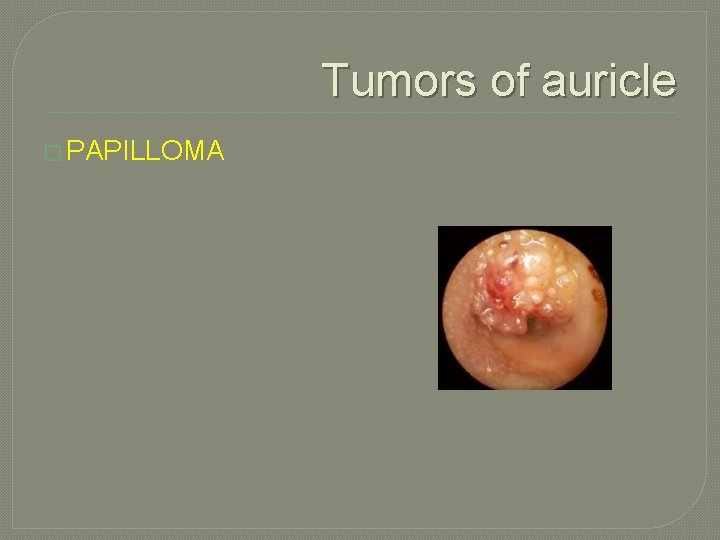 Tumors of auricle � PAPILLOMA 