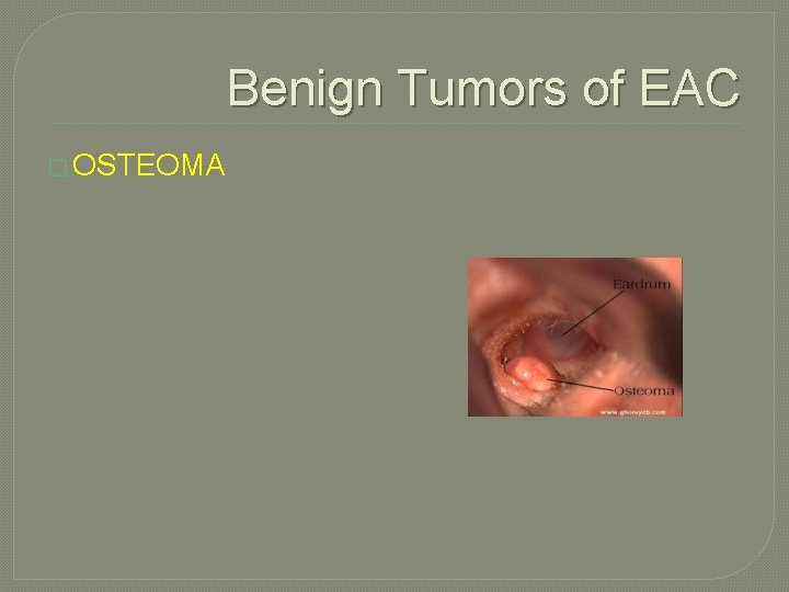 Benign Tumors of EAC � OSTEOMA 